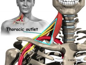 Massage therapy is highly effective in treating thoracic outlet syndrome.